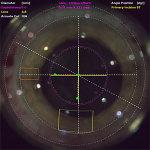 Laser Cataract Surgery