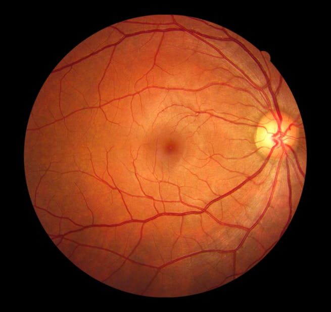 vision loss normal lens normal retina