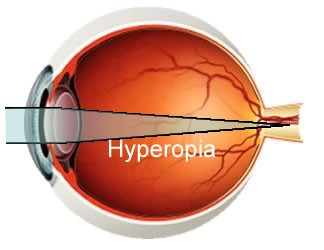 Hyperopia