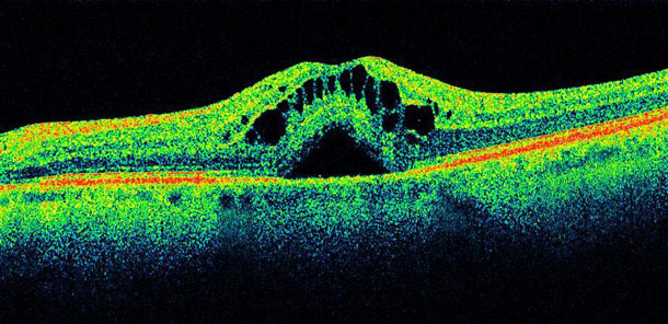 Macular Degeneration